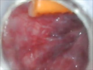 anal deep insertion endoscope inside